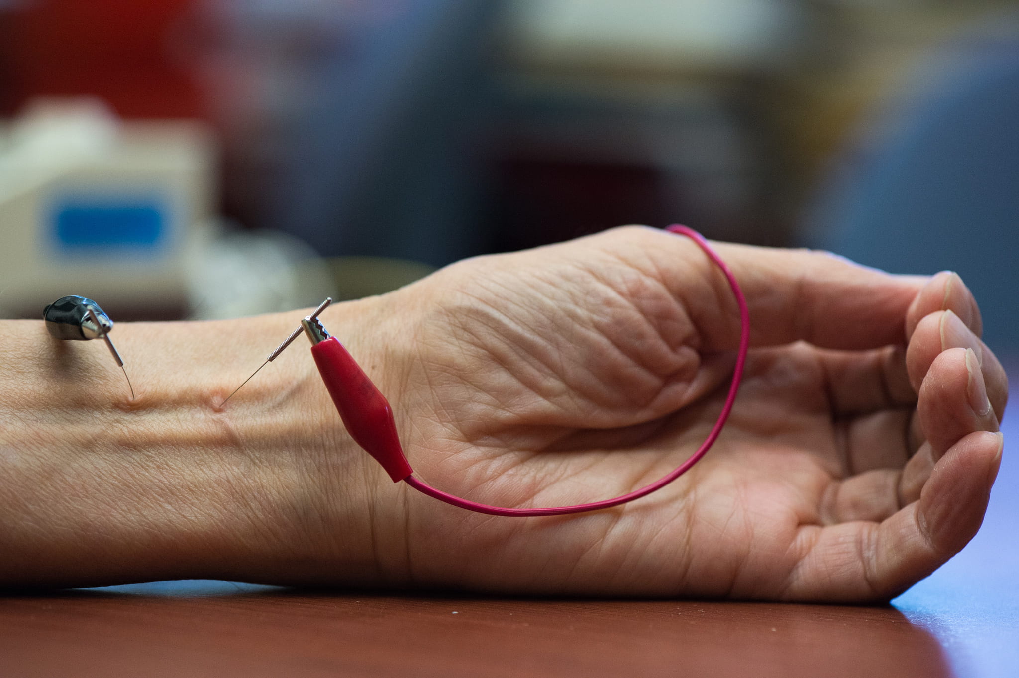 A patient receiving electroacupuncture – a form of acupuncture that employs low-intensity electrical stimulation