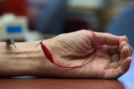 UCI study finds acupuncture lowers hypertension by activating opioids