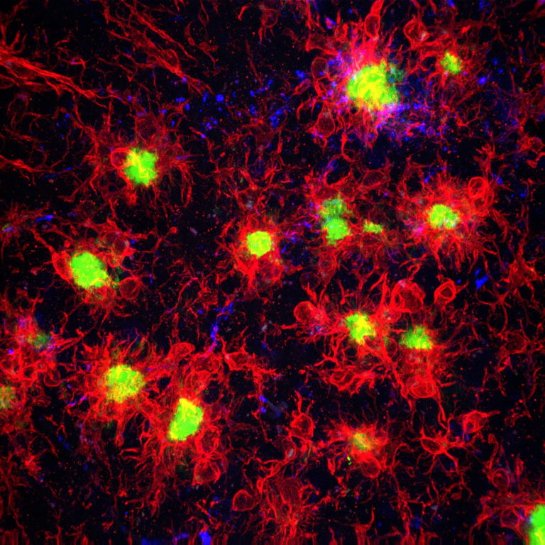 Link between brain immune cells and Alzheimer’s disease development identified